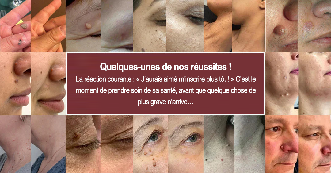 ✨Patch 2-en-1 Curalona® : Microneedle & Hydrocolloïde✨ | Élimine les grains de beauté en relief, les verrues planes et les acrochordons | Aide à atténuer les rides, les cicatrices et les imperfections | Patch invisible adapté au visage et au corps