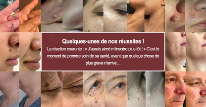 ✨Patch 2-en-1 Curalona® : Microneedle & Hydrocolloïde✨ | Élimine les grains de beauté en relief, les verrues planes et les acrochordons | Aide à atténuer les rides, les cicatrices et les imperfections | Patch invisible adapté au visage et au corps